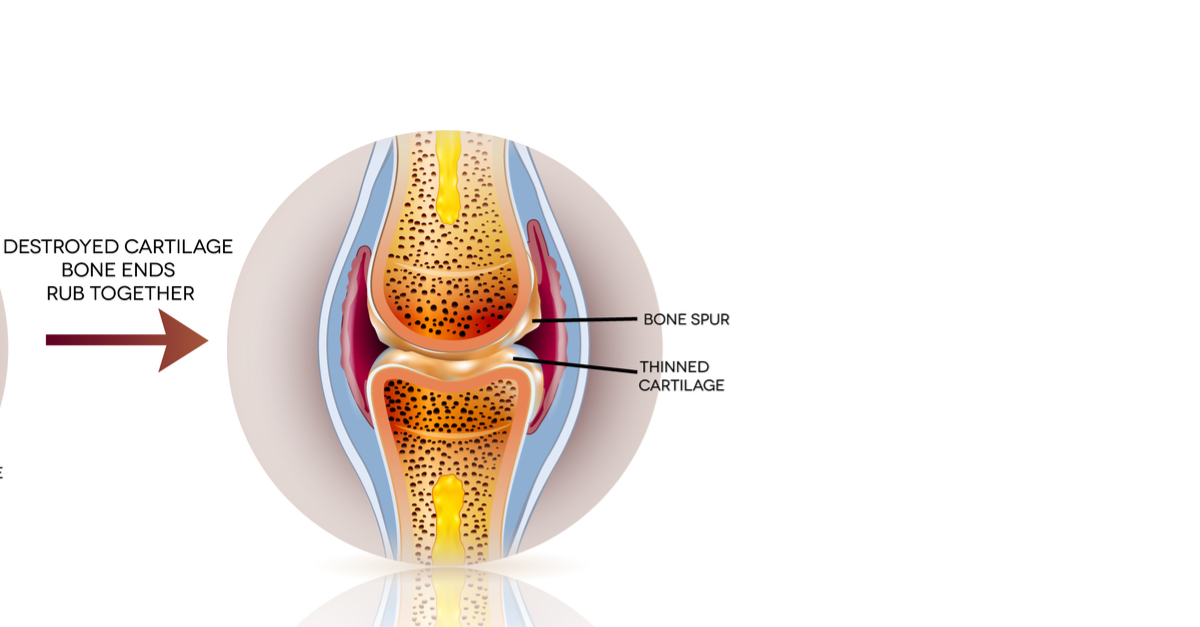 Knee Pain 101: What is a Bone Spur? And How Do I Know If I Have One?