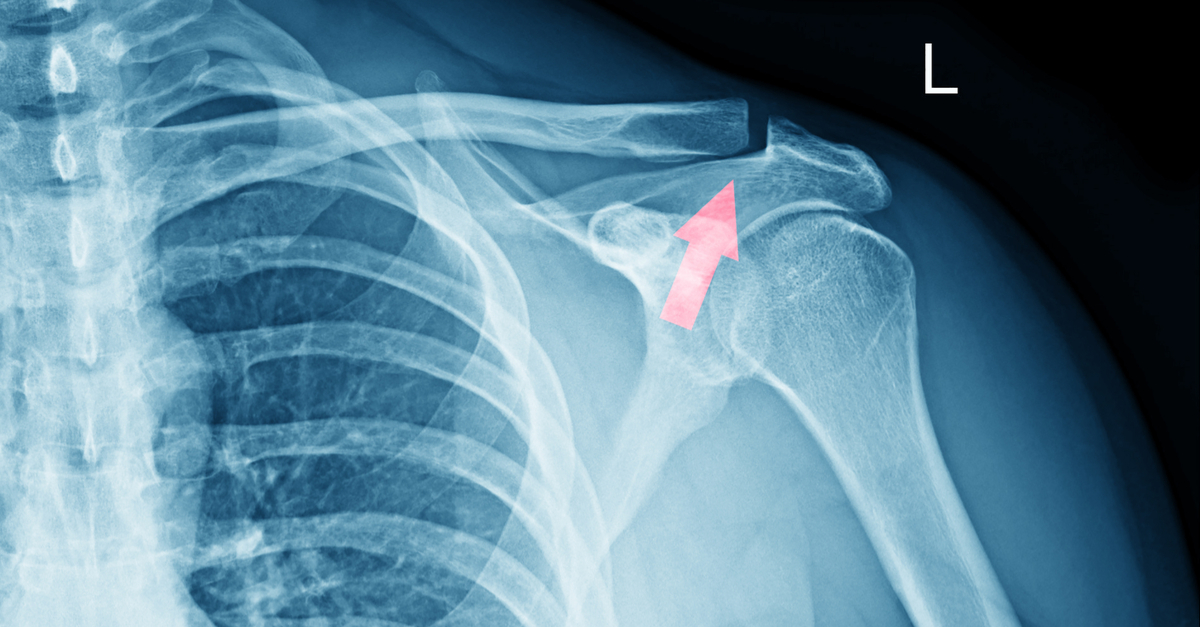 Shoulder Fractures: Causes, Types, Symptoms and Treatments