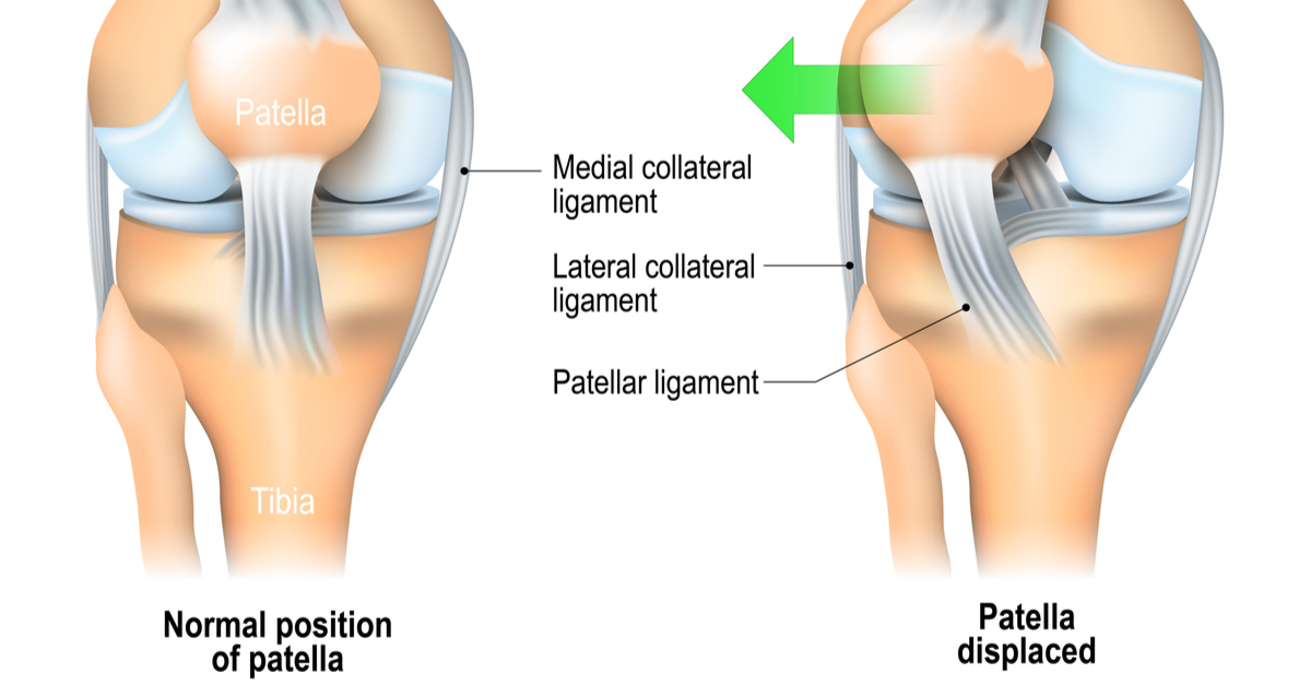 Patellar Dislocations: Signs, Symptoms, Treatments
