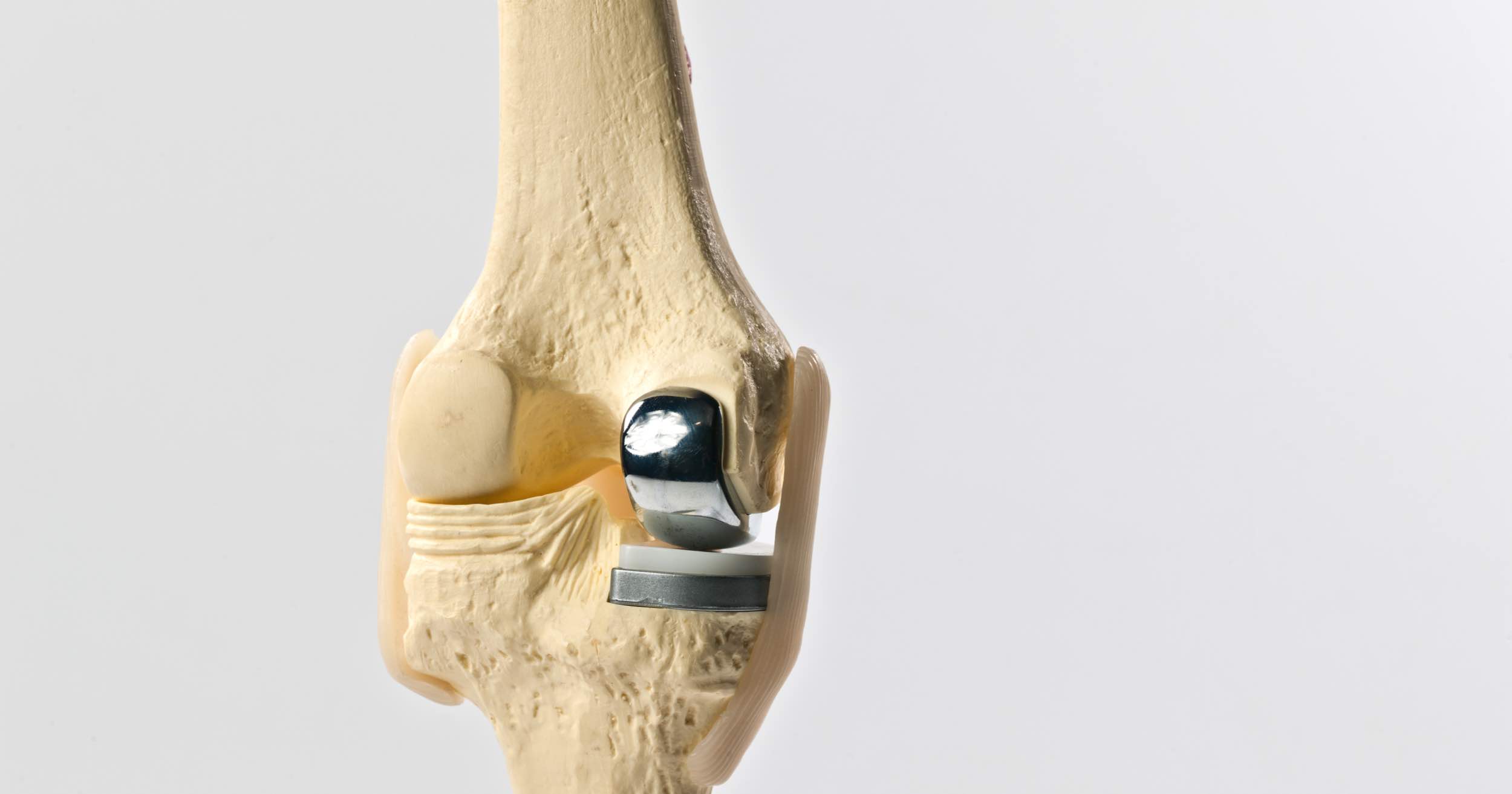 Knee Surgery 101: Partial Knee Replacement