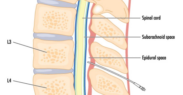 3 Common Questions About Epidural Injections